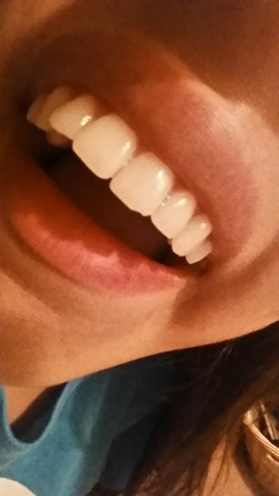 What Is The Best Dental Solution For Small Chip On Bottom Front Tooth And About How Much Would It Cost Photo