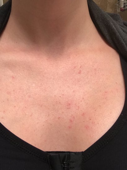 Causes and Remedies For Horrible Rash/ Reaction Post Breast Augmentation?  (photo)