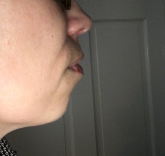 Will a chin implant help with lower lip muscle hypertrophy Photo