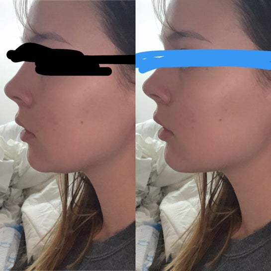 Invisalign Jawline Before And After Reddit Before And After