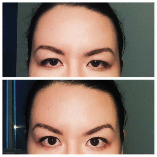 Is A Brow Lift Recommended For Uneven Eyebrows Hooded Asian Eye Angry 11s If Brows Are Naturally Very Arched Photos