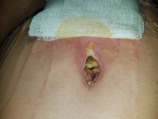 Can necrosis after a tummy tuck occur because to much skin was removed  above the belly button pulling skin too tight? (Photos)
