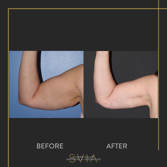 SVIA Plastic Surgery - Home of Liu Plastic Surgery Los Gatos - Los