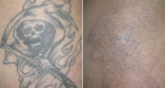 Inkfree, MD - Amazing results after 1 laser tattoo removal treatment with  the PicoPlus!! Some tattoos can be removed in 1-2 treatments. Free  consults. (832) 478-5669. https://bit.ly/2He9SnX #tattooremoval  #houstontattooremoval #picoplus #lutronic ...