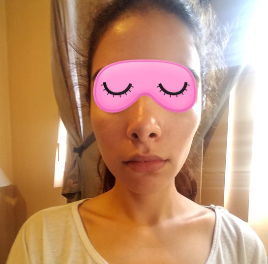 Uneven cheeks after buccal fat removal: why did this happen? (Photo)