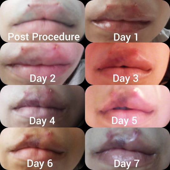 Asymmetrical healing after fat grafting to the lips? I wanted a more  permanent symmetrical look. (Photos)