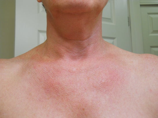 Saggy Chicken Skin On Neck And Decolletage Photo