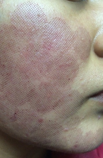 grid marks on face from laser