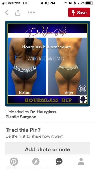 Tummy tuck with lipo on the flanks can create the hourglass shape -  Hourglass Tummy Tuck