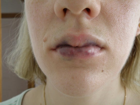 How Long Does Lip Filler Swelling And Bruising Last Lips Makeupview