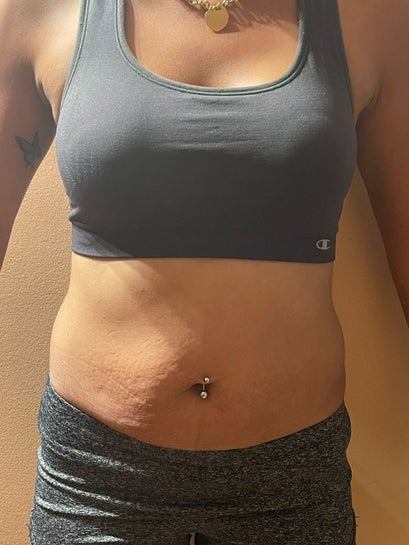 Can a mini tummy tuck and abdominal etching be done on the same day? What  can I do to achieve an hourglass shape? (photos)