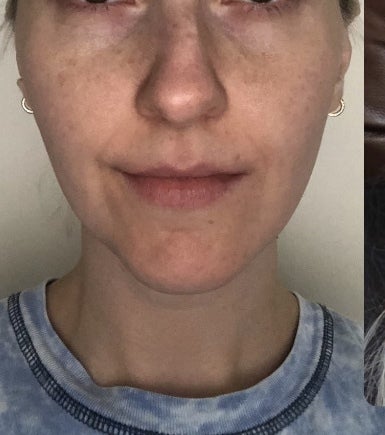Uneven swelling 6 months after rhinoplasty. Is this close to the