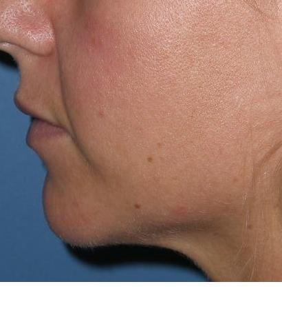 Have You Always Wanted a Chiseled Face? Learn About Buccal Fat Removal -  Ali Sajjadian, MD