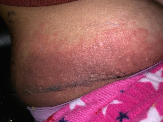 Severe dermatitis (rash) after tummy tuck. Has anyone seen this before?  (Photo)
