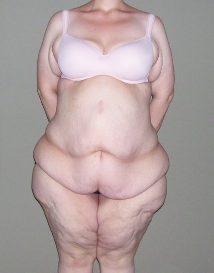 Excess Skin Removal After Massive Weight Loss; LBL or Fleur-de Lis  Abdominoplasty? (photo)