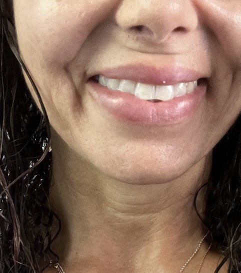 2 Line Filler – So Far Lost How to treat a second smile line with Botox & Filler. - YouTube