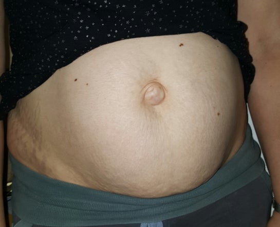 Will My Diastasis And Umbilical Hernia Get Much Worse With Another Pregnancy Photos Will My Diastasis And Umbilical Hernia Get Much Worse With Another Pregnancy Photos
