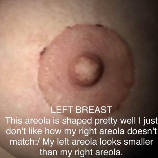 Why are my areolas different from each other in shape and raised up off my  skin where the incisions were made? (Photos)