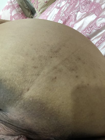 hyperpigmentation cream for inner thighs