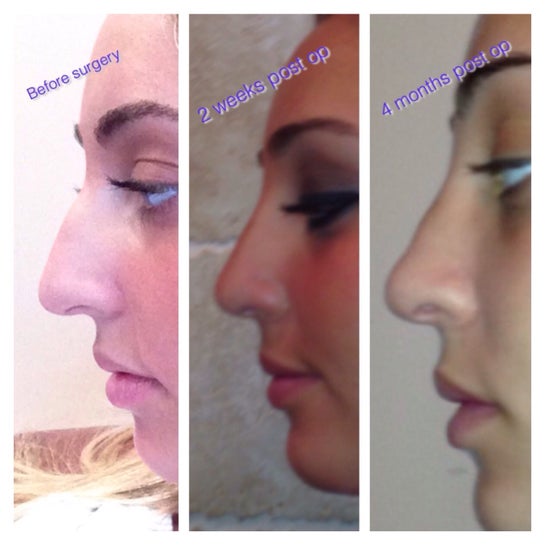 skin-atrophy-nose