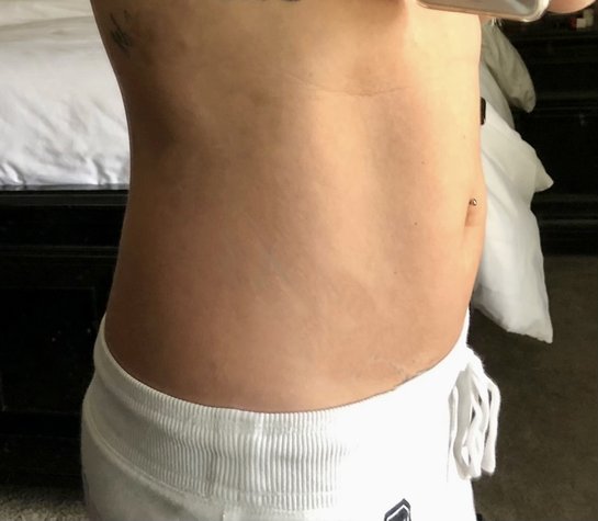 https www.realself.com question lipo-b12-injections-stomach-week 6 months post op lipo on my flanks and upper and lower stomach. Area is dented and lumpy. Can this be fixed? (photos) Best livestock iron supplement