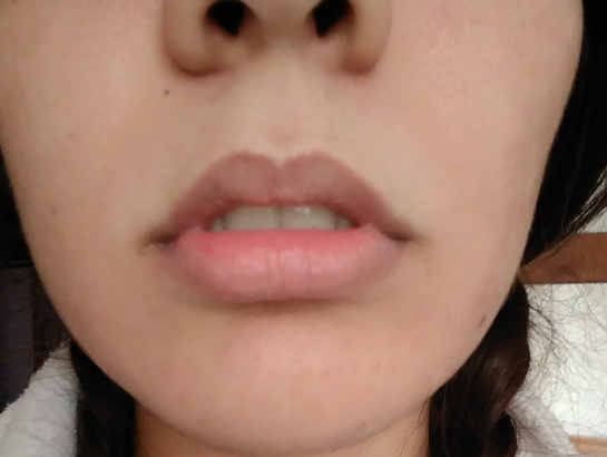 Can t close my lips naturally. Is this normal even after years