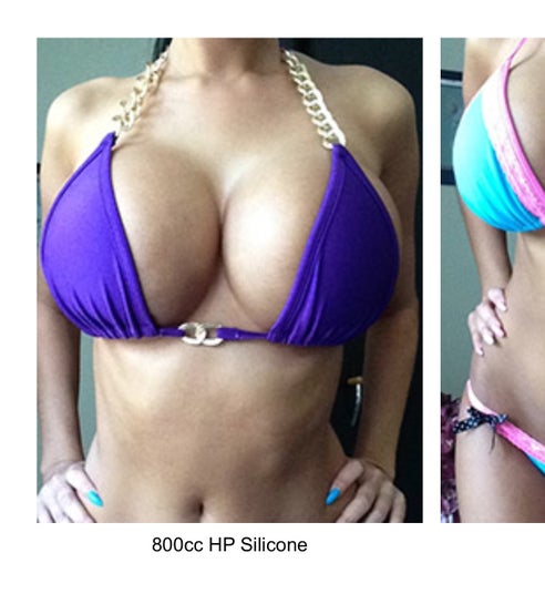 Breast Augmentation With Silicone Implants (B to DDD