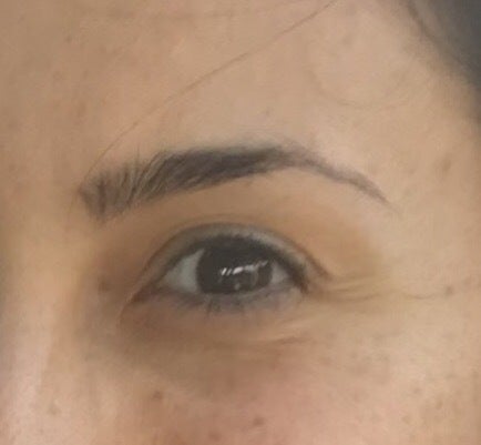fine lines under eyes at 22