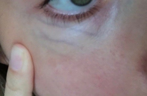 green veins under eyes green veins under eyes