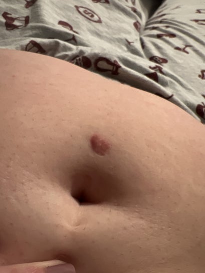 Belly button discount ring scar