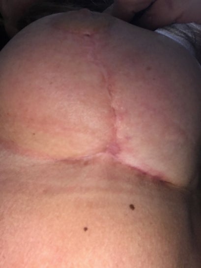 8 weeks post op breast reduction and lift. What can be done about