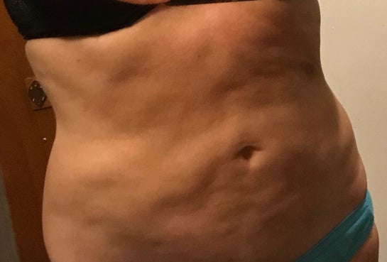 Fat Grafting Or Tummy Tuck For Botched Liposuction Photos