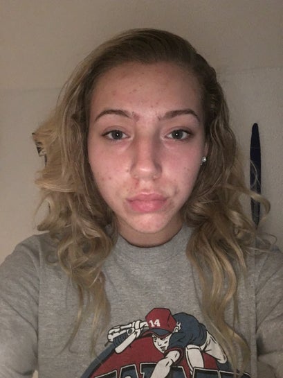 Why is One Cheek Bigger Than the Other: Causes & Solutions Explained