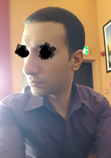 Is It Possible To Have Rhinoplasty Without Osteotomy And How Will It Fix My Nose Photo