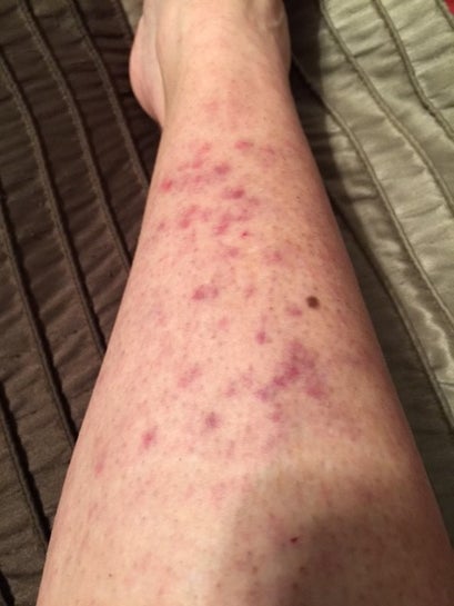 Severe burns after laser hair removal on lower legs. Should I