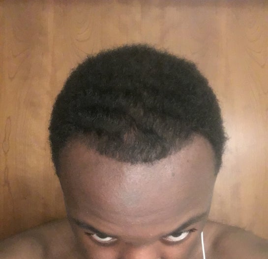 22 Year Old Black Male Embarrassed My Hair Is Thinning And Hairline Receding What Are My Options Photo