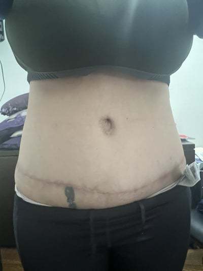 How can I fix my belly button after a tummy tuck? (Photo)