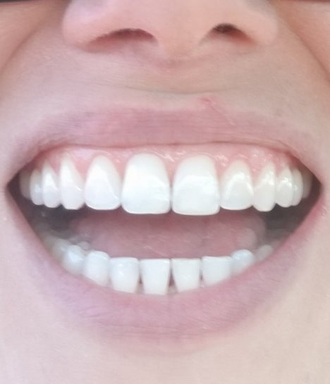 Dental bonding for craze lines? (Photo)