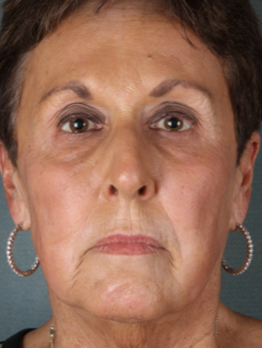 The Modern Grandma's Guide to Using Botox - Azul Cosmetic Surgery and  Medical Spa