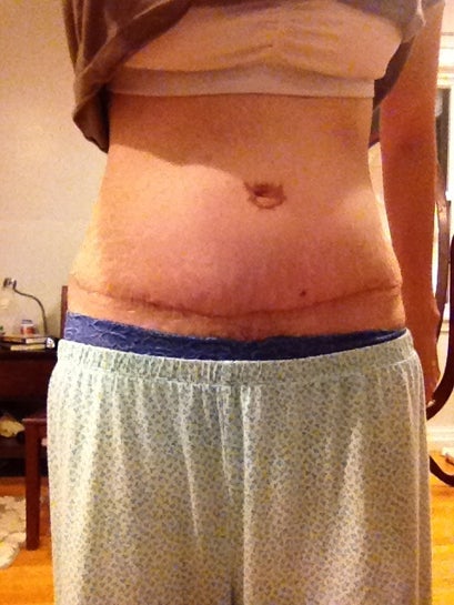 Swelling at 12 weeks post op tummy tuck. Is it normal? (Photo)