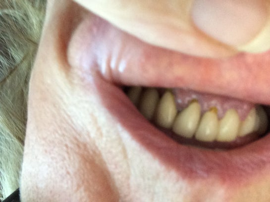 A temp crown caused problems eating, inflamed gums and bleeding. What  should I do? (photo)