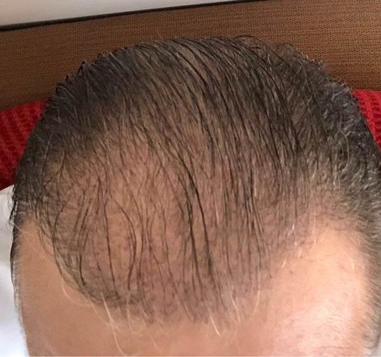 Why Some Hair Transplant Results Take Longer to Grow and Stimulating Hair  Growth After a Transplant  YouTube