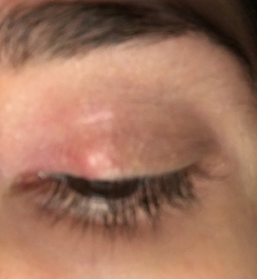 Still a bump on my eyelid after chalazion removal. Will this go away? (Photo) Still a bump on my eyelid after chalazion removal. Will this go away? (Photo)