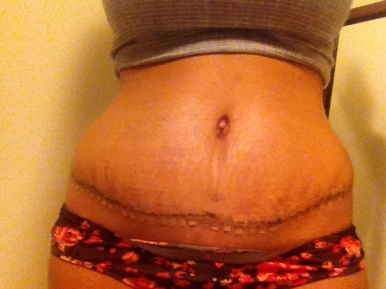 How long after a tummy tuck hot sale can i get my bellybutton pierced