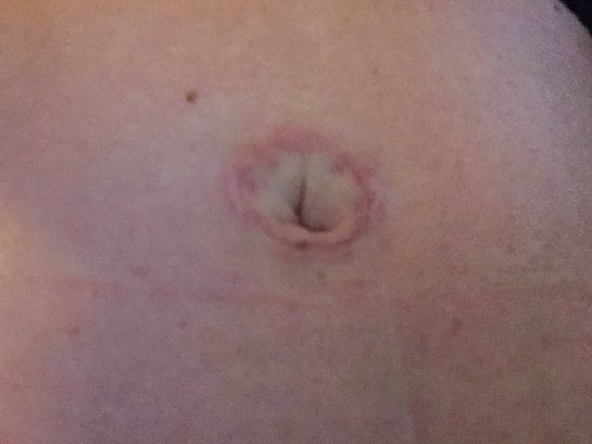 Why is my scar outside my belly button after Tummy tuck photos