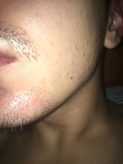 Can I remove my beard transplant grafts by electrolysis 4 months