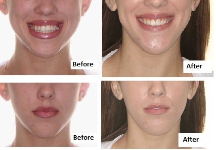 Bicuspid Extractions Changed Face Negatively