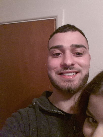 Swelling Wont Go 1 Year After Bone Graft Upper Maxilla Photo