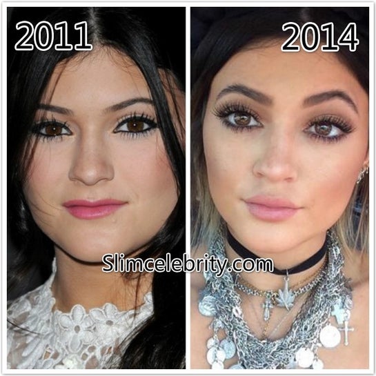 What did Kylie Jenner do to make her eyes bigger and eyelids sultry