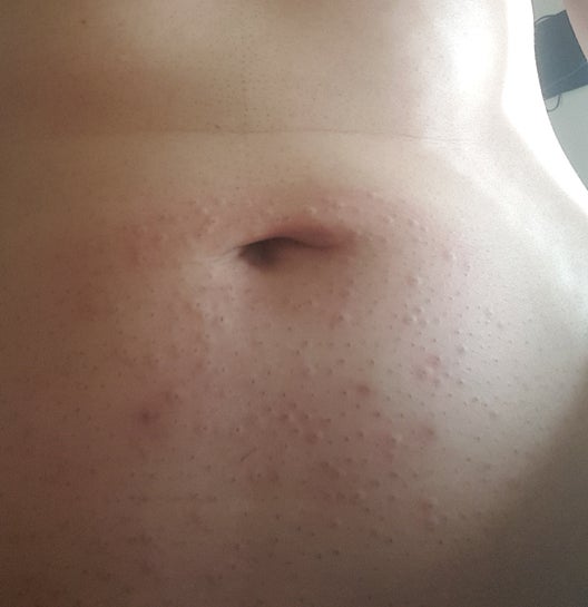 Large red bumps after laser hair removal still present 2 weeks